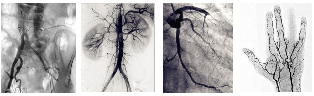 介入c臂机临床图片 介入c臂机临床图片