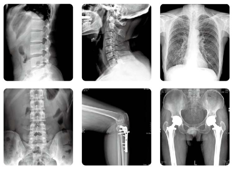 LX8500C镰刀臂dr临床影像 LX8500C镰刀臂dr临床影像