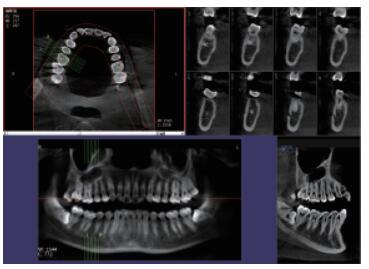 口腔CBCT 三维重建任意断层 口腔CBCT 三维重建任意断层