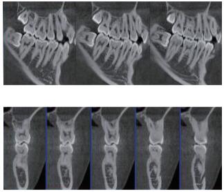 口腔CBCT 多平面组合重建 口腔CBCT 多平面组合重建