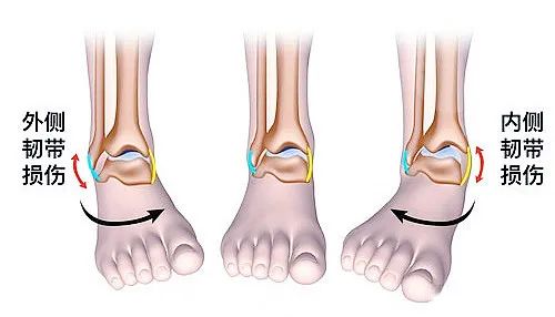 【医疗科普】之为什么说踝关节骨折手术复杂？