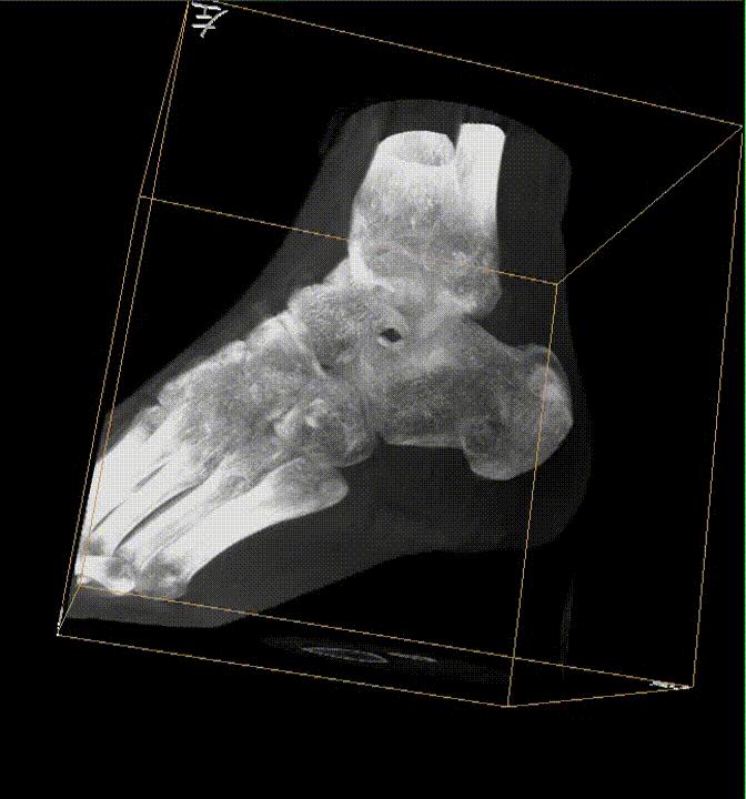 【医疗科普】之为什么说踝关节骨折手术复杂？