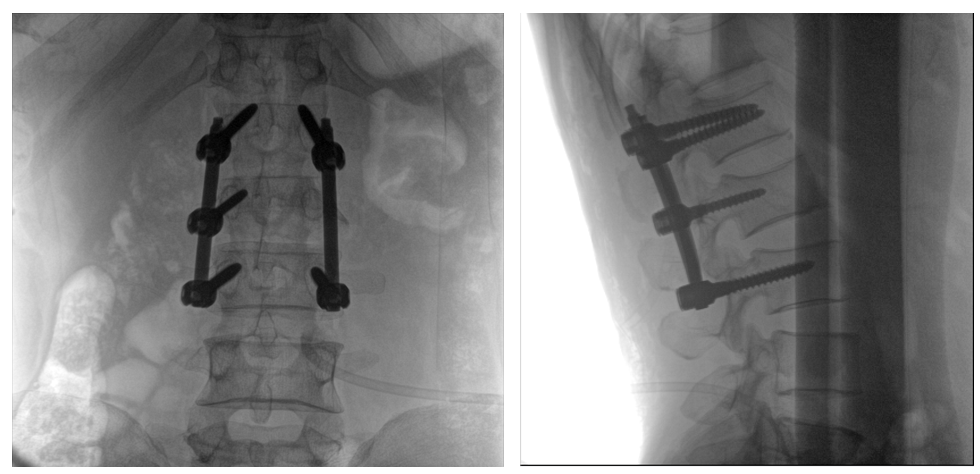 一体式C形臂全节段腰椎临床影像 一体式C形臂全节段腰椎临床影像