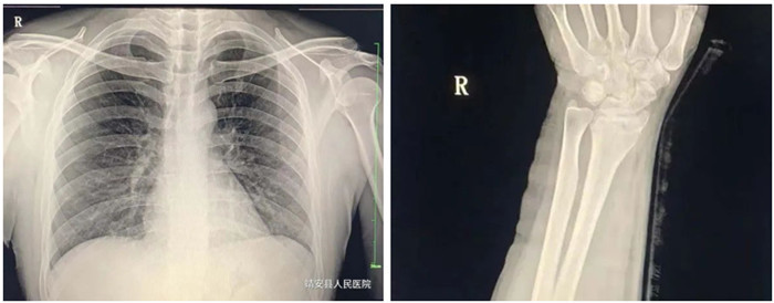 动态DR影像 动态DR影像