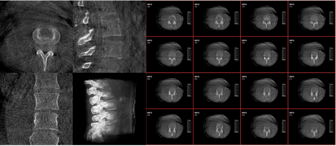 术中三维C臂的优势:三维影像功能 术中三维C臂的优势:三维影像功能
