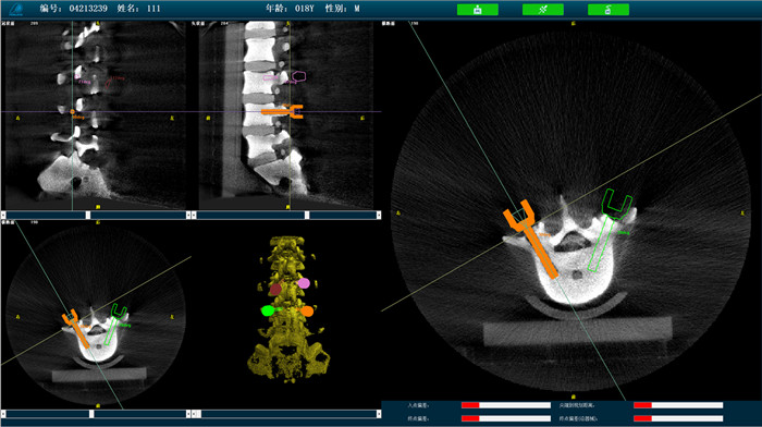 机器人手术系统3D影像 机器人手术系统3D影像