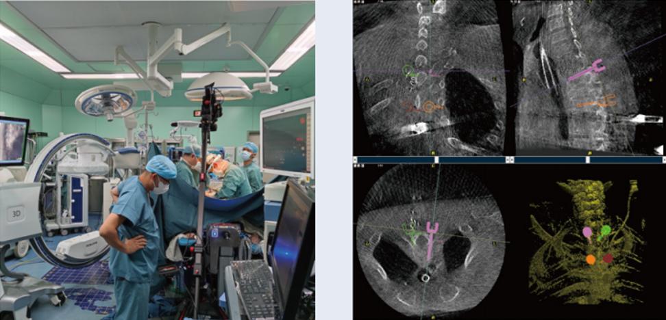 三维C臂与骨科导航机器人配合应用(助力骨科手术更准确) 三维C臂与骨科导航机器人配合应用(助力骨科手术更准确)