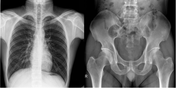 固定悬吊dr临床图像 固定悬吊dr临床图像