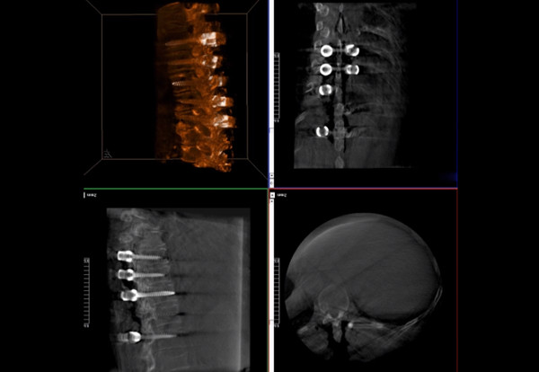 术中三维导航C臂影像 术中三维导航C臂影像