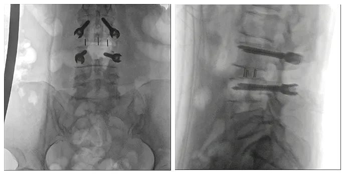 术中三维导航C臂影像 术中三维导航C臂影像