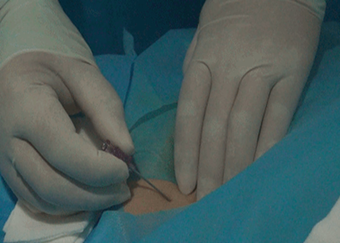 介入治疗 介入治疗