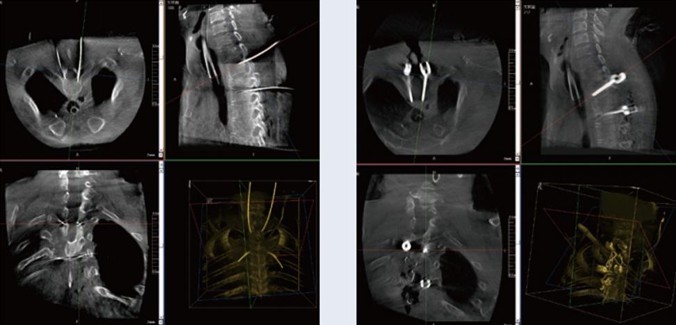术中三维C形臂影像在脊柱导航机器人系统中的应用 术中三维C形臂影像在脊柱导航机器人系统中的应用