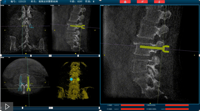 骨科机器人路线规划 骨科机器人路线规划