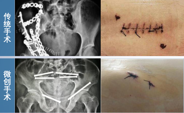 骨科机器人微创手术 骨科机器人微创手术