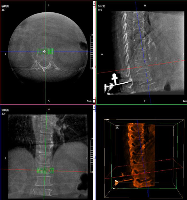 C形臂三维重建+骨科机器人手术规划 C形臂三维重建+骨科机器人手术规划