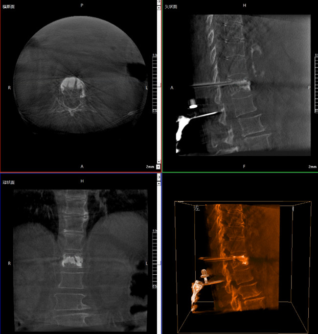 骨科机器人影像 骨科机器人影像