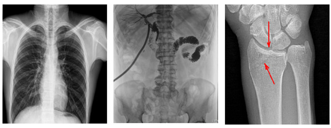 悬吊动态DR临床图像 悬吊动态DR临床图像