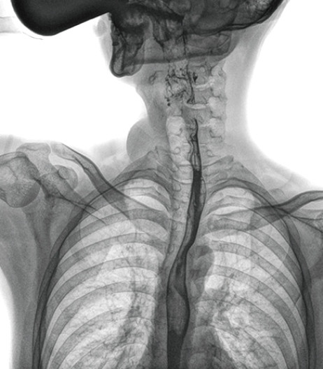 动态DR上消化道造影 动态DR上消化道造影