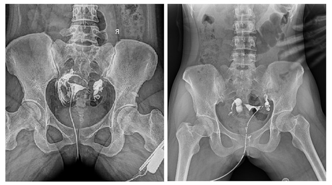 动态DR造影 动态DR造影