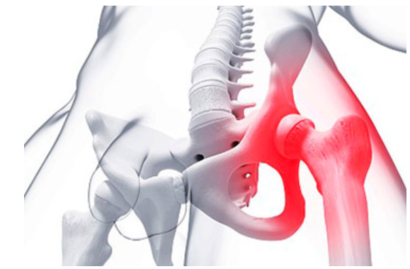 骨盆骨折 骨盆骨折