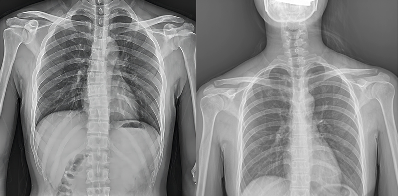 百微米DR与普通像素尺寸DR的影像对比 百微米DR与普通像素尺寸DR的影像对比