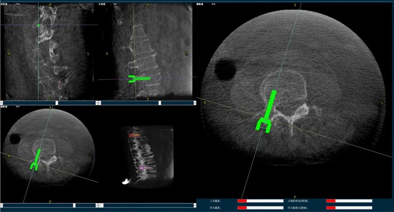 使用机器人做椎体成形术的过程1 使用机器人做椎体成形术的过程1