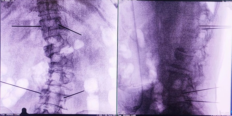 使用机器人做椎体成形术的过程2 使用机器人做椎体成形术的过程2