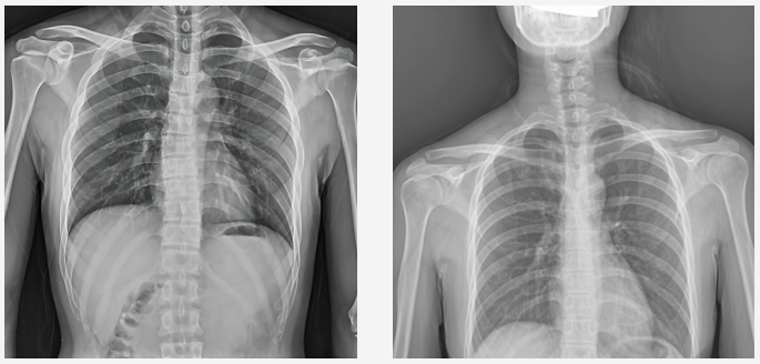 普爱动态DR临床图像 普爱动态DR临床图像