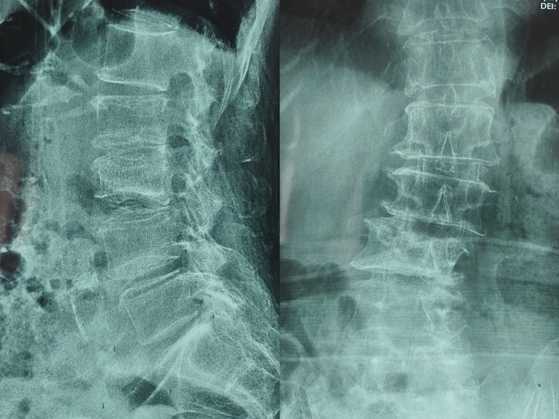 机器人辅助腰椎后路侧弯矫形手术术前图像 机器人辅助腰椎后路侧弯矫形手术术前图像