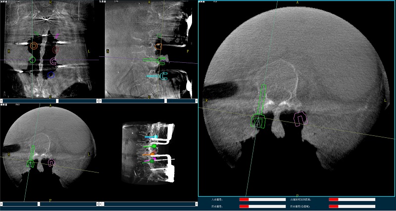 机器人辅助腰椎后路侧弯矫形手术规划图像 机器人辅助腰椎后路侧弯矫形手术规划图像