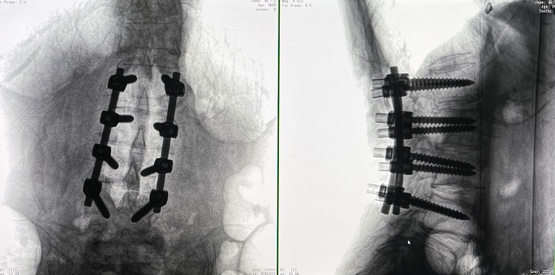 机器人辅助腰椎后路侧弯矫形手术术后图像 机器人辅助腰椎后路侧弯矫形手术术后图像