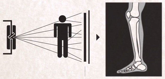 使用滤线栅之后的图像更清晰 使用滤线栅之后的图像更清晰