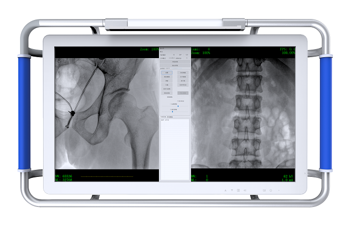 C臂机的图像质量 C臂机的图像质量