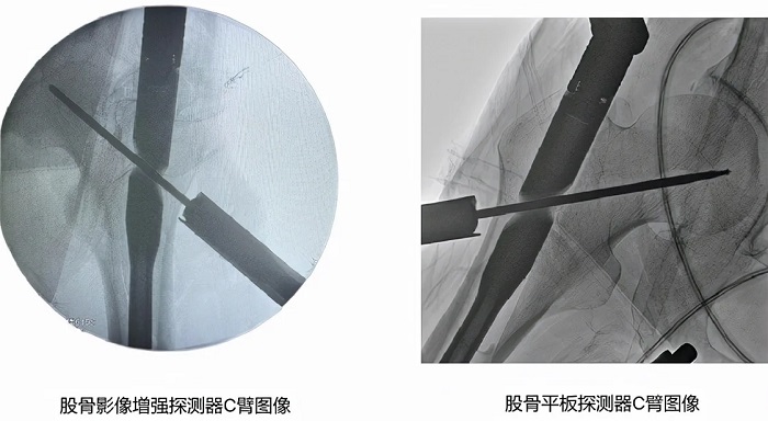 影增C臂和平板C臂图像对比 影增C臂和平板C臂图像对比