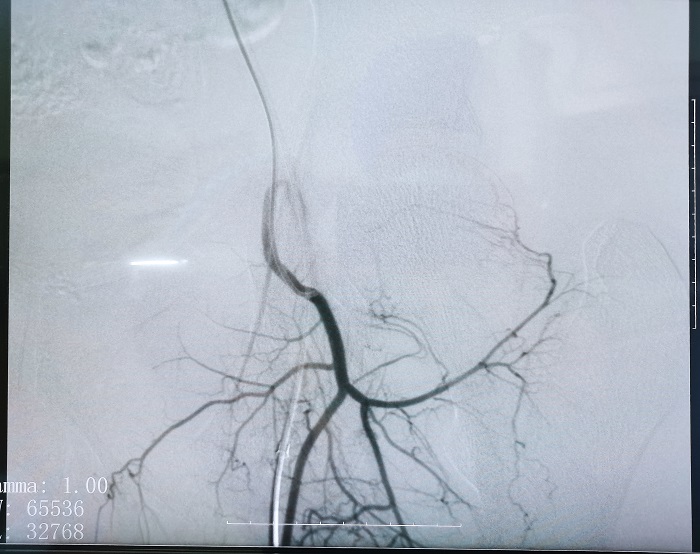 普爱平板介入中C在FTE手术过程中拍摄的造影图像 普爱平板介入中C在FTE手术过程中拍摄的造影图像