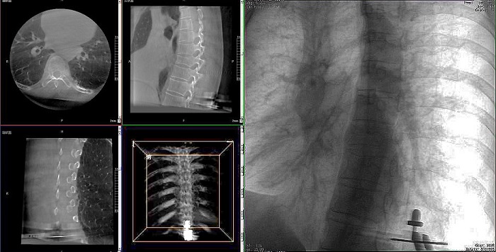 机器人做胸椎手术影像 机器人做胸椎手术影像