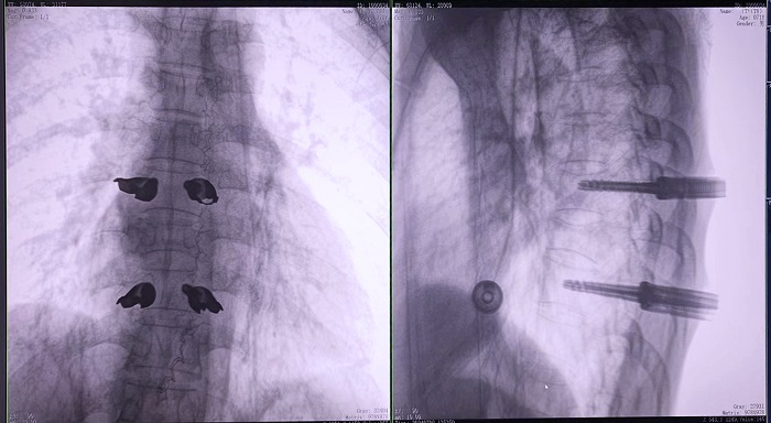 机器人做胸椎置钉手术 机器人做胸椎置钉手术