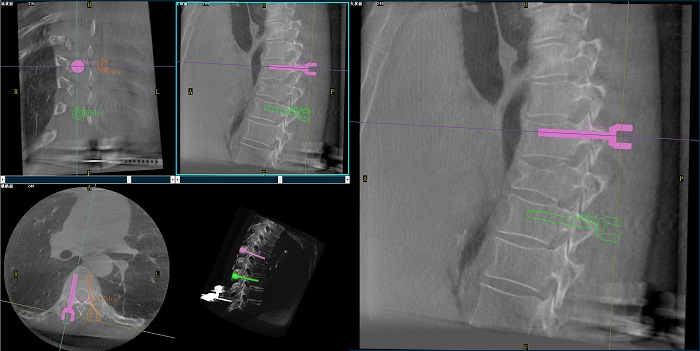机器人做胸椎手术图像 机器人做胸椎手术图像