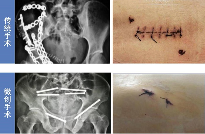 脊柱外科手术导航定位系统的微创手术 脊柱外科手术导航定位系统的微创手术