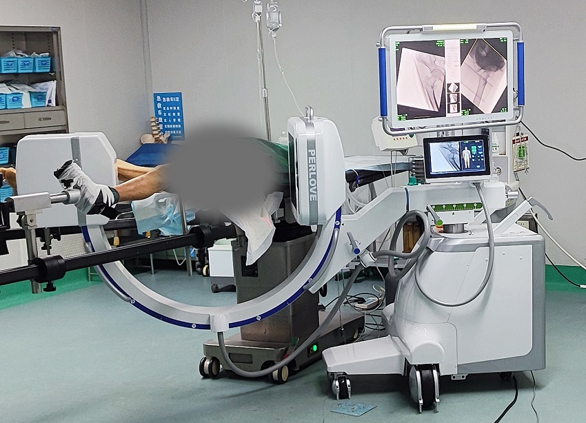 骨科手术C臂机在瑞丽市人民医院 骨科手术C臂机在瑞丽市人民医院