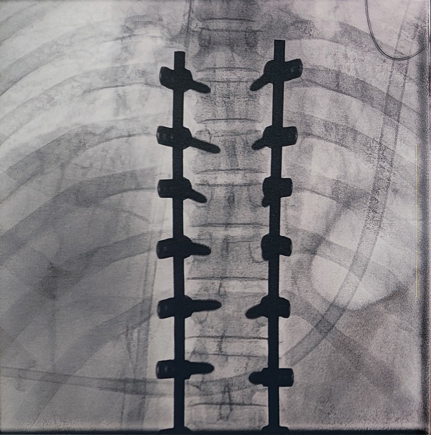 骨科手术C臂机临床图像 骨科手术C臂机临床图像