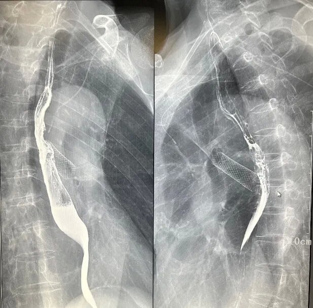 数字胃肠透视机食道造影 数字胃肠透视机食道造影