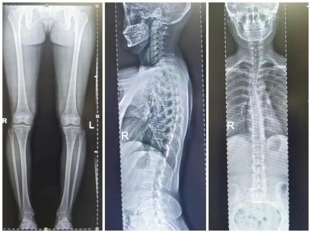 数字胃肠透视机全脊柱摄影 数字胃肠透视机全脊柱摄影