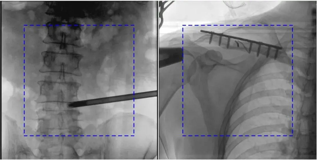C臂机图像不清楚 C臂机图像不清楚