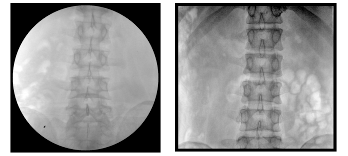 移动式平板C形臂X射线机腰椎图像 移动式平板C形臂X射线机腰椎图像