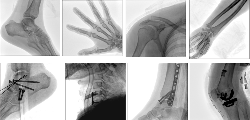 移动式平板C形臂X射线机临床影像 移动式平板C形臂X射线机临床影像